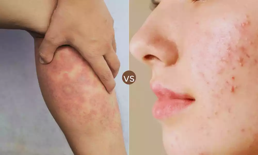 Acne and Eczema