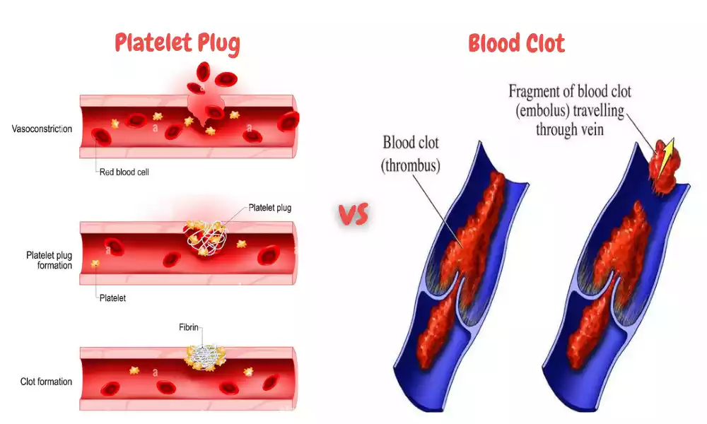 Platelet Plug and Blood Clot