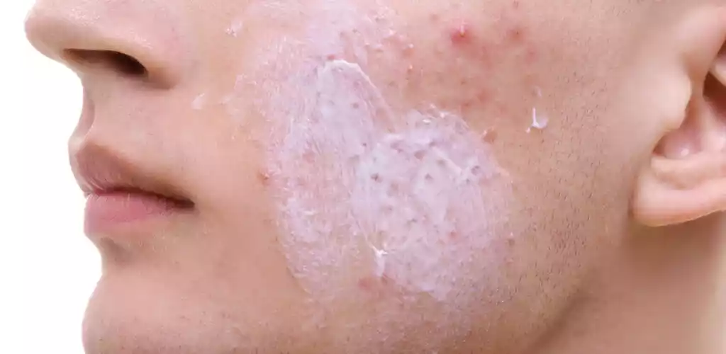 Treatment of Acne