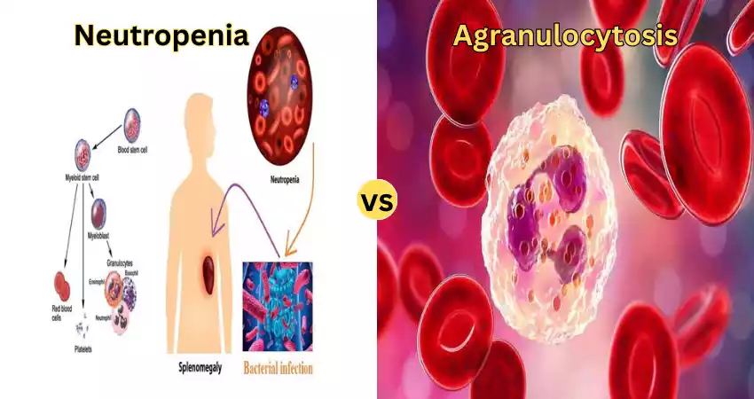 Difference Between Neutropenia and Agranulocytosis