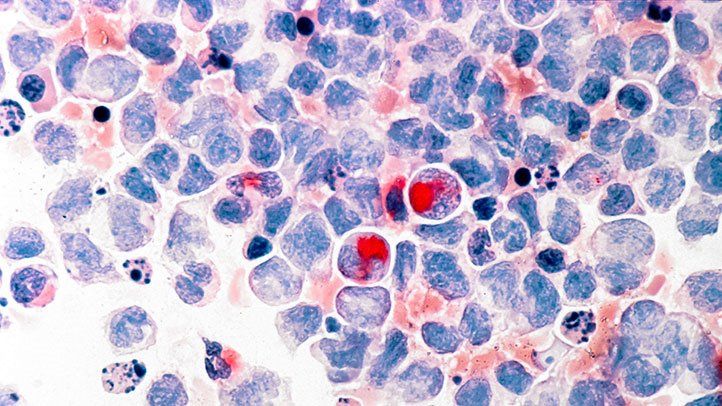 Lymphocytic Leukemia