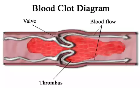 Blood Clot