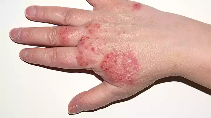 Eczema