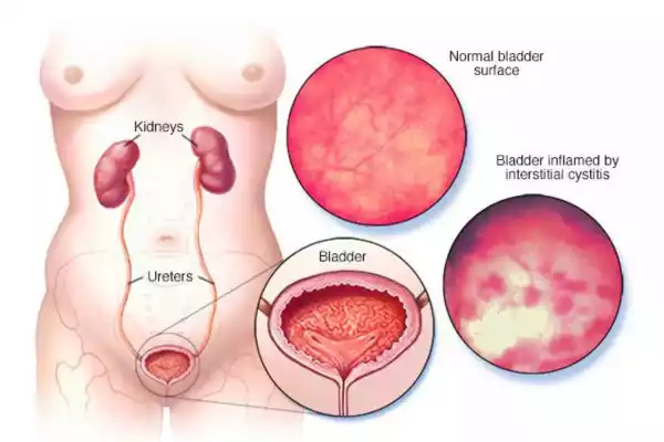 Interstitial Cystitis