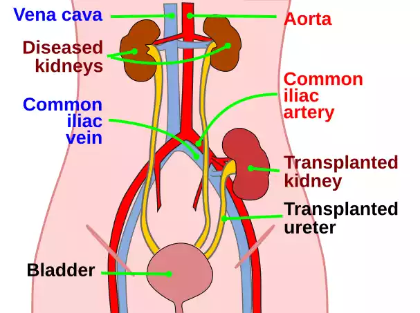 Kidney Transplant