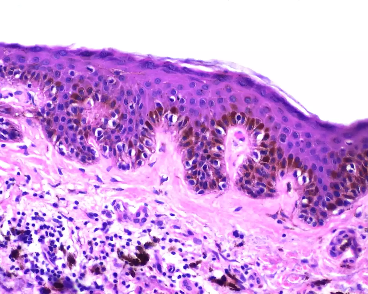 Nevus Cells