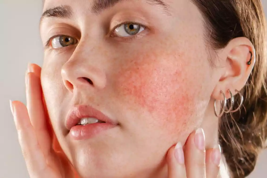 Rosacea