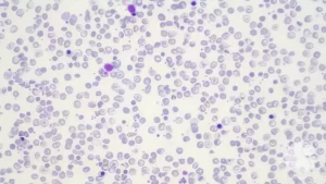 Thalassemia Major