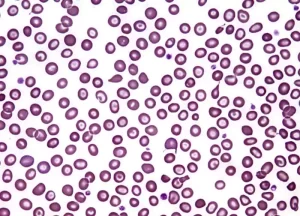 Thalassemia Minor